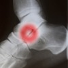 upload/articles/thumbs/240113113738ankle and foot oa.jpg